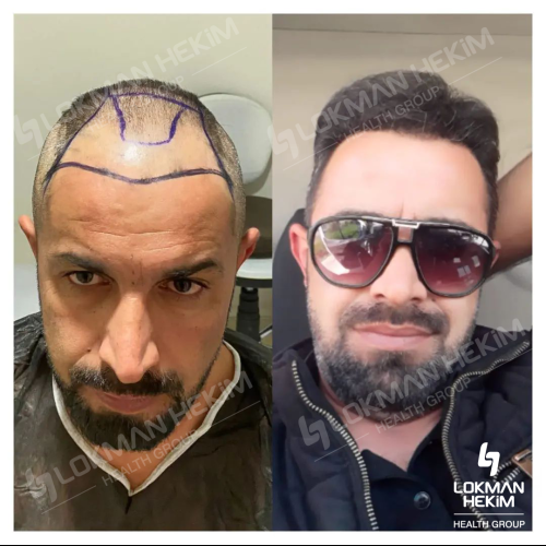 زراعة الشعر صور قبل وبعد
